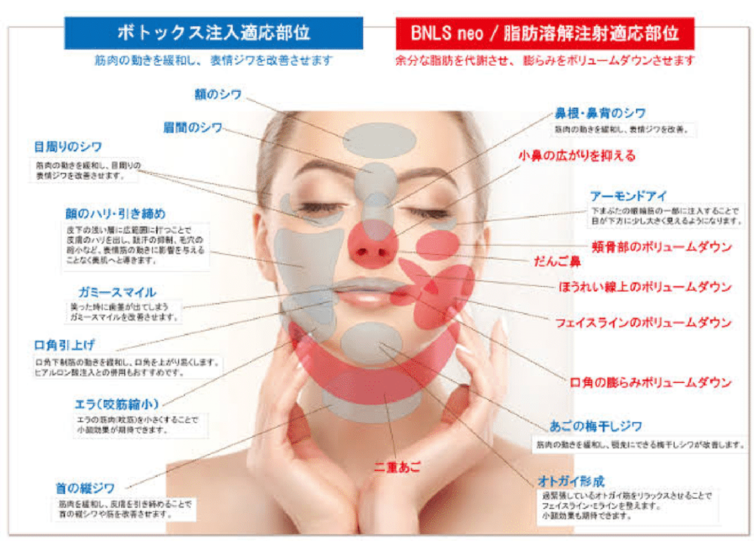 ボトックス注射